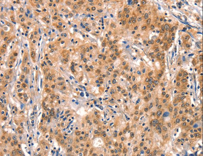 AIMP1 / EMAP II Antibody - Immunohistochemistry of paraffin-embedded Human gastric cancer using AIMP1 Polyclonal Antibody at dilution of 1:40.
