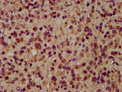 AIMP1 / EMAP II Antibody - Immunohistochemistry image at a dilution of 1:200 and staining in paraffin-embedded human glioma cancer performed on a Leica BondTM system. After dewaxing and hydration, antigen retrieval was mediated by high pressure in a citrate buffer (pH 6.0) . Section was blocked with 10% normal goat serum 30min at RT. Then primary antibody (1% BSA) was incubated at 4 °C overnight. The primary is detected by a biotinylated secondary antibody and visualized using an HRP conjugated SP system.