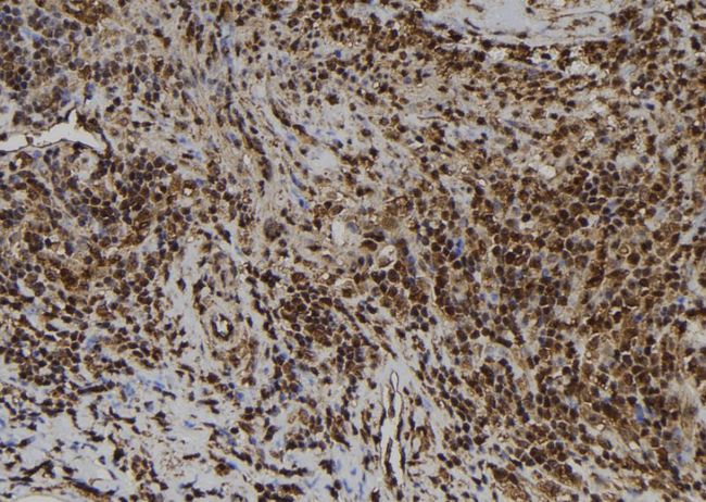 AIMP1 / EMAP II Antibody - 1:100 staining human spleen tissue by IHC-P. The sample was formaldehyde fixed and a heat mediated antigen retrieval step in citrate buffer was performed. The sample was then blocked and incubated with the antibody for 1.5 hours at 22°C. An HRP conjugated goat anti-rabbit antibody was used as the secondary.