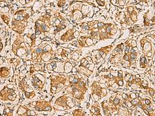 AIMP1 / EMAP II Antibody - Immunohistochemistry of paraffin-embedded Human liver cancer tissue  using AIMP1 Polyclonal Antibody at dilution of 1:55(×200)