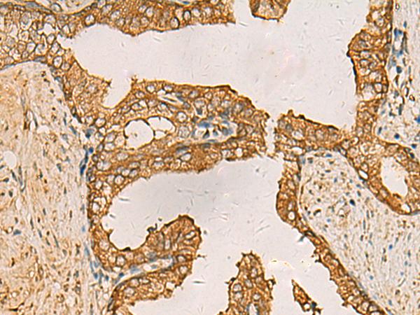 AIMP1 / EMAP II Antibody - Immunohistochemistry of paraffin-embedded Human prost ate cancer tissue  using AIMP1 Polyclonal Antibody at dilution of 1:55(×200)