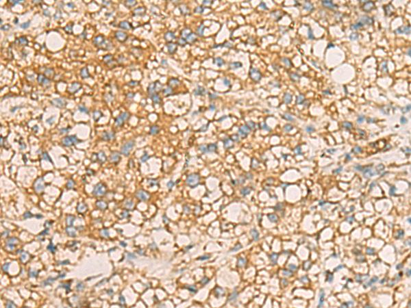 AIMP1 / EMAP II Antibody - Immunohistochemistry of paraffin-embedded Human liver cancer tissue  using AIMP1 Polyclonal Antibody at dilution of 1:40(×200)