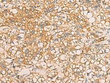 AIMP1 / EMAP II Antibody - Immunohistochemistry of paraffin-embedded Human liver cancer tissue  using AIMP1 Polyclonal Antibody at dilution of 1:40(×200)