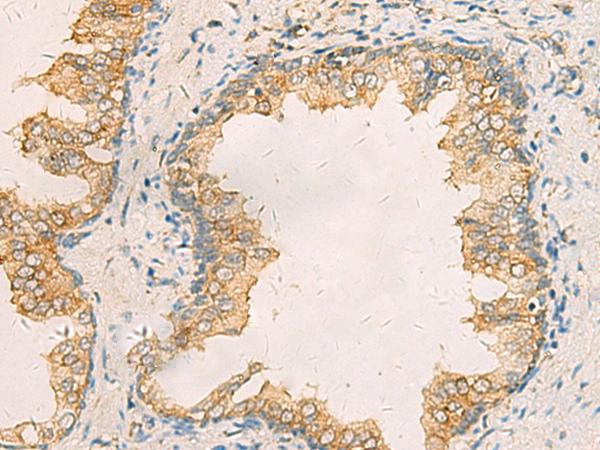 AIMP1 / EMAP II Antibody - Immunohistochemistry of paraffin-embedded Human prost ate cancer tissue  using AIMP1 Polyclonal Antibody at dilution of 1:40(×200)