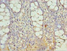 AIMP2 Antibody - Immunohistochemistry of paraffin-embedded human rectal cancer using antibody at 1:100 dilution.