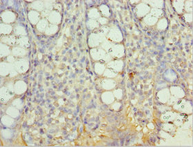 AIMP2 Antibody - Immunohistochemistry of paraffin-embedded human colon cancer using AIMP2 Antibody at dilution of 1:100
