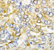 AIMP2 Antibody - AIMP2 antibody. IHC(P): Human Rectal Cancer Tissue.