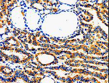 AIMP2 Antibody - Immunohistochemistry of paraffin-embedded Human thyroid cancer using AIMP2 Polyclonal Antibody at dilution of 1:50.