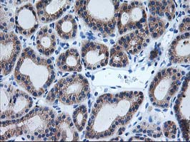 AIPL1 Antibody - IHC of paraffin-embedded Carcinoma of Human thyroid tissue using anti-AIPL1 mouse monoclonal antibody.