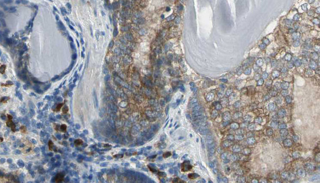 AK1 / Adenylate Kinase 1 Antibody - 1:100 staining human prostate tissue by IHC-P. The sample was formaldehyde fixed and a heat mediated antigen retrieval step in citrate buffer was performed. The sample was then blocked and incubated with the antibody for 1.5 hours at 22°C. An HRP conjugated goat anti-rabbit antibody was used as the secondary.