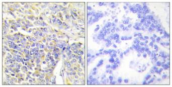 AK1 / Adenylate Kinase 1 Antibody - Peptide - + Immunohistochemistry analysis of paraffin-embedded human lung carcinoma tissue, using KAD1 antibody.