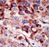 AK2 / Adenylate Kinase 2 Antibody - Formalin-fixed and paraffin-embedded human cancer tissue reacted with the primary antibody, which was peroxidase-conjugated to the secondary antibody, followed by AEC staining. This data demonstrates the use of this antibody for immunohistochemistry; clinical relevance has not been evaluated. BC = breast carcinoma; HC = hepatocarcinoma.