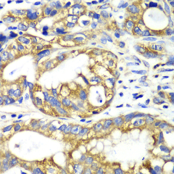 AK2 / Adenylate Kinase 2 Antibody - Immunohistochemistry of paraffin-embedded human gastric cancer tissue.