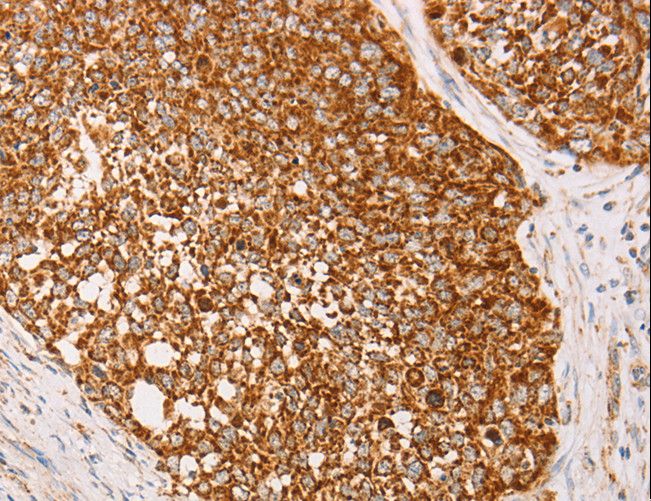 AK2 / Adenylate Kinase 2 Antibody - Immunohistochemistry of paraffin-embedded Human cervical cancer using AK2 Polyclonal Antibody at dilution of 1:40.