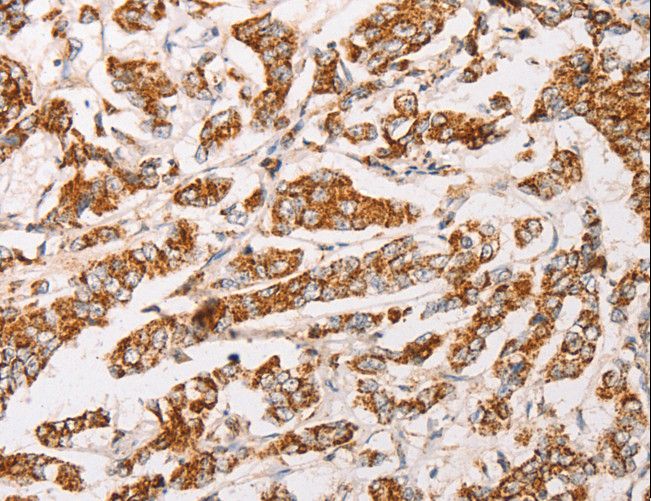 AK2 / Adenylate Kinase 2 Antibody - Immunohistochemistry of paraffin-embedded Human breast cancer using AK2 Polyclonal Antibody at dilution of 1:30.