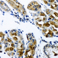 AK2 / Adenylate Kinase 2 Antibody - Immunohistochemical analysis of AK2 staining in human gastric cancer formalin fixed paraffin embedded tissue section. The section was pre-treated using heat mediated antigen retrieval with sodium citrate buffer (pH 6.0). The section was then incubated with the antibody at room temperature and detected using an HRP conjugated compact polymer system. DAB was used as the chromogen. The section was then counterstained with hematoxylin and mounted with DPX.