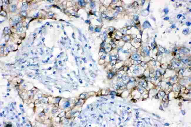 AK2 / Adenylate Kinase 2 Antibody - AK2 was detected in paraffin-embedded sections of human lung cancer tissues using rabbit anti- AK2 Antigen Affinity purified polyclonal antibody