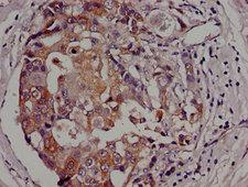 AK3 / Adenylate Kinase 3 Antibody - Immunohistochemistry image of paraffin-embedded human breast cancer at a dilution of 1:100