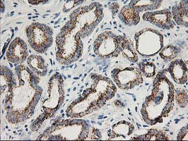 AK4 / Adenylate Kinase 4 Antibody - IHC of paraffin-embedded Carcinoma of Human prostate tissue using anti-AK4 mouse monoclonal antibody.