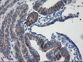 AK4 / Adenylate Kinase 4 Antibody - IHC of paraffin-embedded Adenocarcinoma of Human endometrium tissue using anti-AK4 mouse monoclonal antibody.