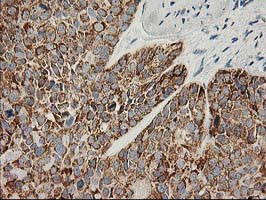 AK4 / Adenylate Kinase 4 Antibody - IHC of paraffin-embedded Adenocarcinoma of Human breast tissue using anti-AK4 mouse monoclonal antibody.