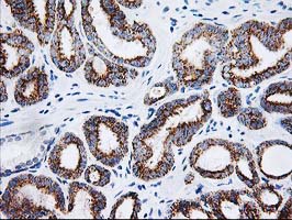 AK4 / Adenylate Kinase 4 Antibody - IHC of paraffin-embedded Carcinoma of Human prostate tissue using anti-AK4 mouse monoclonal antibody.