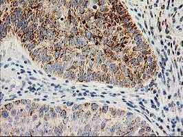AK4 / Adenylate Kinase 4 Antibody - IHC of paraffin-embedded Carcinoma of Human bladder tissue using anti-AK4 mouse monoclonal antibody.