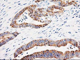 AK4 / Adenylate Kinase 4 Antibody - IHC of paraffin-embedded Adenocarcinoma of Human colon tissue using anti-AK4 mouse monoclonal antibody.