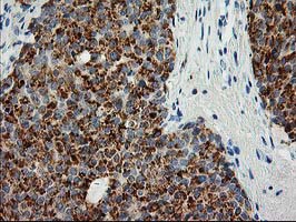 AK4 / Adenylate Kinase 4 Antibody - IHC of paraffin-embedded Carcinoma of Human liver tissue using anti-AK4 mouse monoclonal antibody.