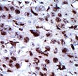 AK5 / Adenylate Kinase 5 Antibody - Formalin-fixed and paraffin-embedded human cancer tissue reacted with the primary antibody, which was peroxidase-conjugated to the secondary antibody, followed by AEC staining. This data demonstrates the use of this antibody for immunohistochemistry; clinical relevance has not been evaluated. BC = breast carcinoma; HC = hepatocarcinoma.