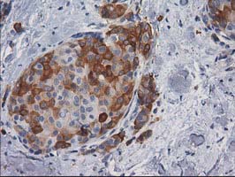 AK5 / Adenylate Kinase 5 Antibody - IHC of paraffin-embedded Adenocarcinoma of Human breast tissue using anti-AK5 mouse monoclonal antibody.