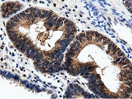 AK5 / Adenylate Kinase 5 Antibody - IHC of paraffin-embedded Adenocarcinoma of Human endometrium tissue using anti-AK5 mouse monoclonal antibody.