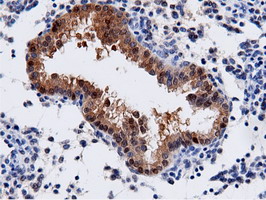 AK5 / Adenylate Kinase 5 Antibody - IHC of paraffin-embedded Carcinoma of Human prostate tissue using anti-AK5 mouse monoclonal antibody.