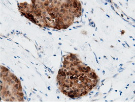 AK5 / Adenylate Kinase 5 Antibody - Immunohistochemical staining of paraffin-embedded Adenocarcinoma of Human breast tissue using anti-AK5 mouse monoclonal antibody.