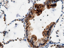 AK5 / Adenylate Kinase 5 Antibody - Immunohistochemical staining of paraffin-embedded Carcinoma of Human lung tissue using anti-AK5 mouse monoclonal antibody.