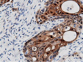 AK5 / Adenylate Kinase 5 Antibody - Immunohistochemical staining of paraffin-embedded Carcinoma of Human pancreas tissue using anti-AK5 mouse monoclonal antibody.