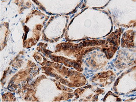 AK5 / Adenylate Kinase 5 Antibody - Immunohistochemical staining of paraffin-embedded Carcinoma of Human thyroid tissue using anti-AK5 mouse monoclonal antibody.