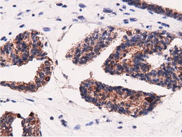 AK5 / Adenylate Kinase 5 Antibody - Immunohistochemical staining of paraffin-embedded Adenocarcinoma of Human endometrium tissue using anti-AK5 mouse monoclonal antibody.