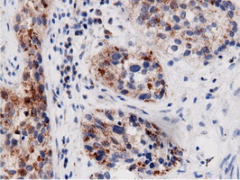 AK5 / Adenylate Kinase 5 Antibody - Immunohistochemical staining of paraffin-embedded Carcinoma of Human bladder tissue using anti-AK5 mouse monoclonal antibody.