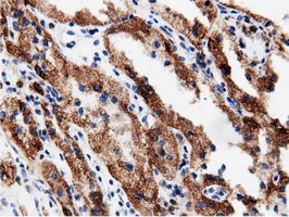 AK5 / Adenylate Kinase 5 Antibody - Immunohistochemical staining of paraffin-embedded Carcinoma of Human kidney tissue using anti-AK5 mouse monoclonal antibody.