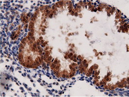 AK5 / Adenylate Kinase 5 Antibody - Immunohistochemical staining of paraffin-embedded Carcinoma of Human prostate tissue using anti-AK5 mouse monoclonal antibody.