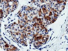 AK5 / Adenylate Kinase 5 Antibody - IHC of paraffin-embedded Adenocarcinoma of Human breast tissue using anti-AK5 mouse monoclonal antibody.