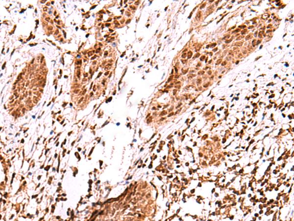 AK9 / AKD1 / AKD2 Antibody - Immunohistochemistry of paraffin-embedded Human esophagus cancer tissue  using AK9 Polyclonal Antibody at dilution of 1:60(×200)