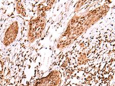 AK9 / AKD1 / AKD2 Antibody - Immunohistochemistry of paraffin-embedded Human esophagus cancer tissue  using AK9 Polyclonal Antibody at dilution of 1:60(×200)