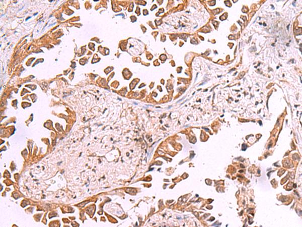 AK9 / AKD1 / AKD2 Antibody - Immunohistochemistry of paraffin-embedded Human lung cancer tissue  using AK9 Polyclonal Antibody at dilution of 1:85(×200)