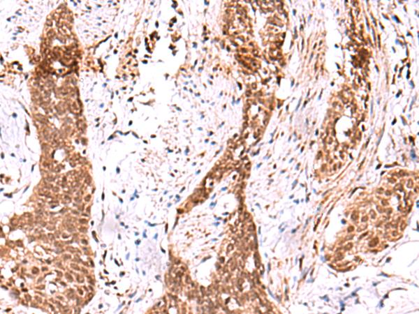 AK9 / AKD1 / AKD2 Antibody - Immunohistochemistry of paraffin-embedded Human esophagus cancer tissue  using AK9 Polyclonal Antibody at dilution of 1:85(×200)