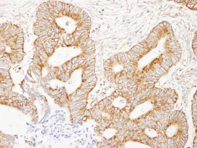 AKAP1 / AKAP Antibody - Detection of Human AKAP1 by Immunohistochemistry. Sample: FFPE section of human colon carcinoma. Antibody: Affinity purified rabbit anti-AKAP1 used at a dilution of 1:250.