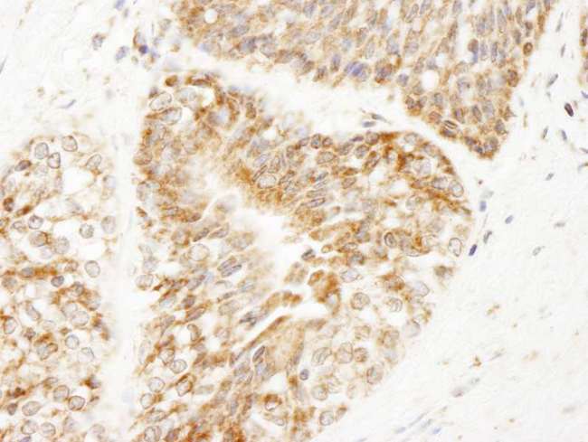 AKAP1 / AKAP Antibody - Detection of Human AKAP1 by Immunohistochemistry. Sample: FFPE section of human prostate carcinoma. Antibody: Affinity purified rabbit anti-AKAP1 used at a dilution of 1:250.