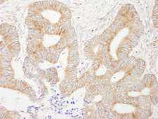 AKAP1 / AKAP Antibody - Detection of Human AKAP1 by Immunohistochemistry. Sample: FFPE section of human colon carcinoma. Antibody: Affinity purified rabbit anti-AKAP1 used at a dilution of 1:200 (1 ug/ml).