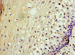 AKAP10 Antibody - Immunohistochemistry of paraffin-embedded human cervical cancer using antibody at 1:100 dilution.